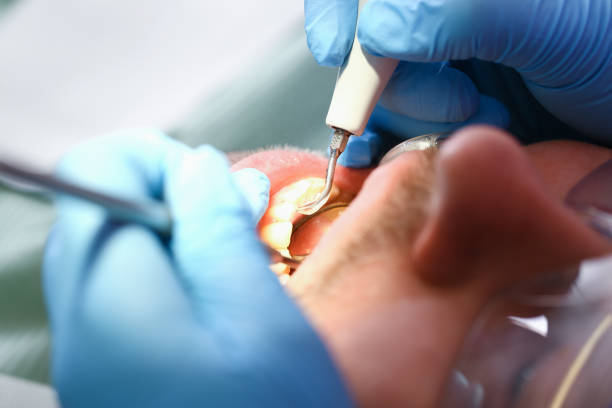 Best Emergency Treatment for Dental Infections or Abscesses in Saranac, MI
